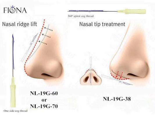 Ascenseur de nez de fil de dent de PCL 70mm remodelant le traitement